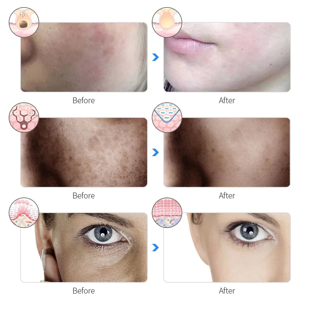 GlowLift™ Pro — for Wrinkles, Acne & Skin Firming LED Therapy Mask
